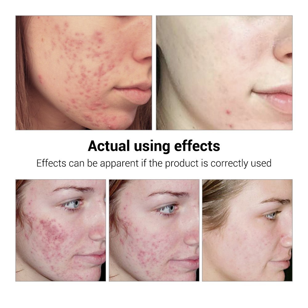 BREYLEE Acne Treatment Serum Face Facial