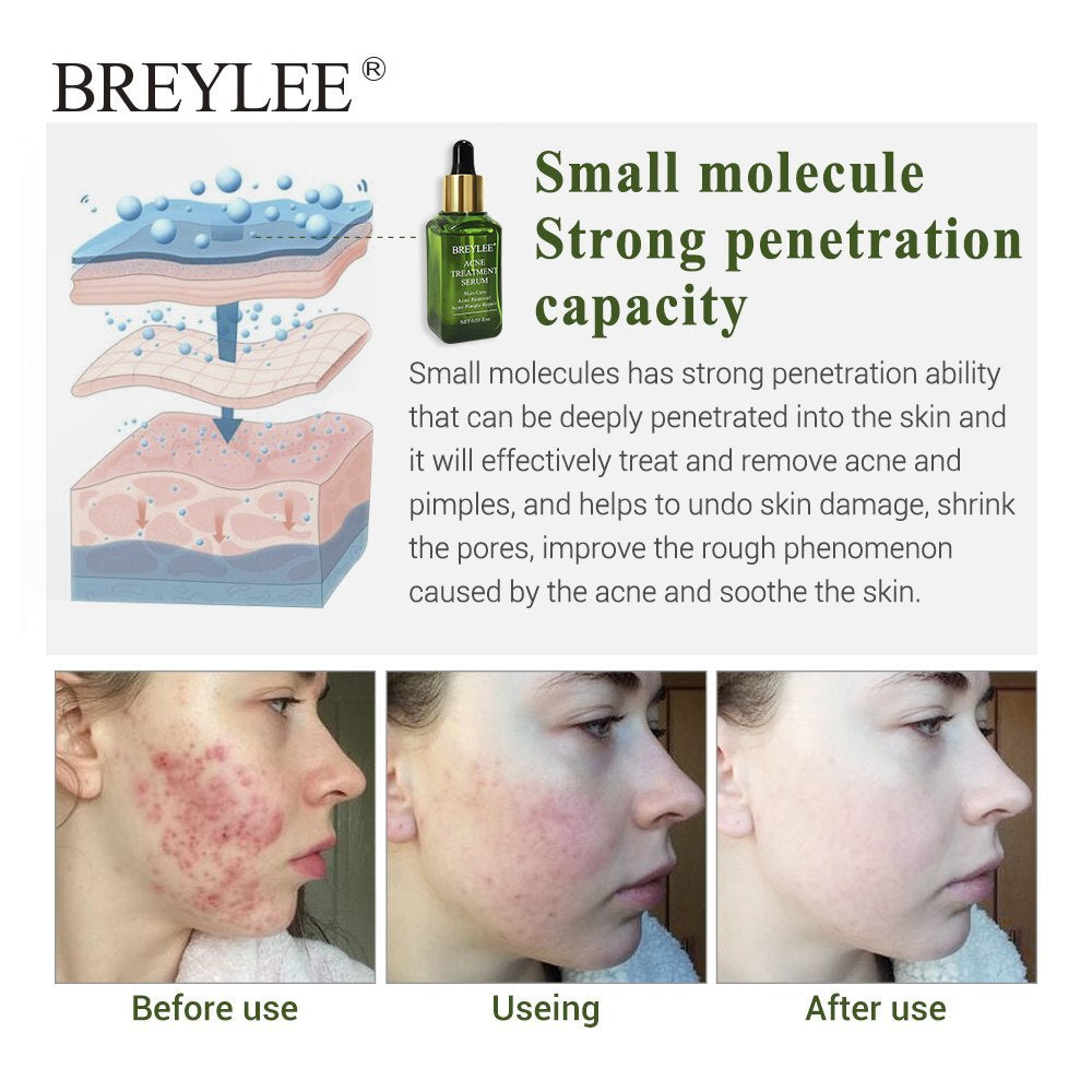 BREYLEE Acne Treatment Serum Face Facial