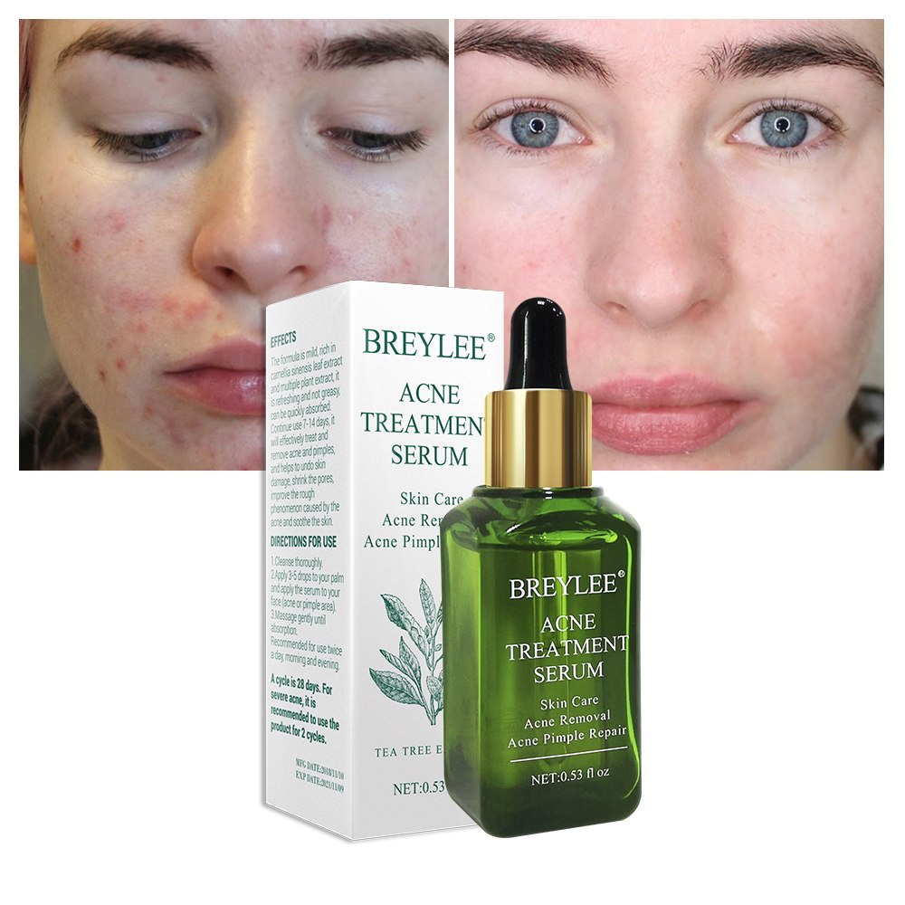 BREYLEE Acne Treatment Serum Face Facial