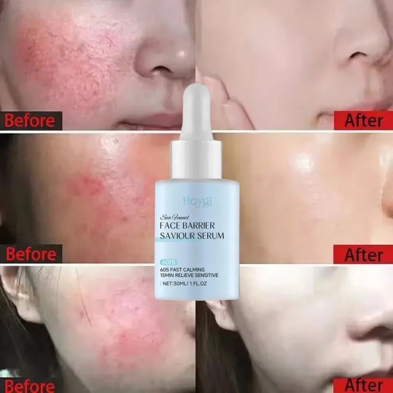 Facial Redness Repair Serum Improve Sensitive Skin Dryness Moisturizer Hydrating Sooth Lotion Removal Rosacea Korean Cosmetics